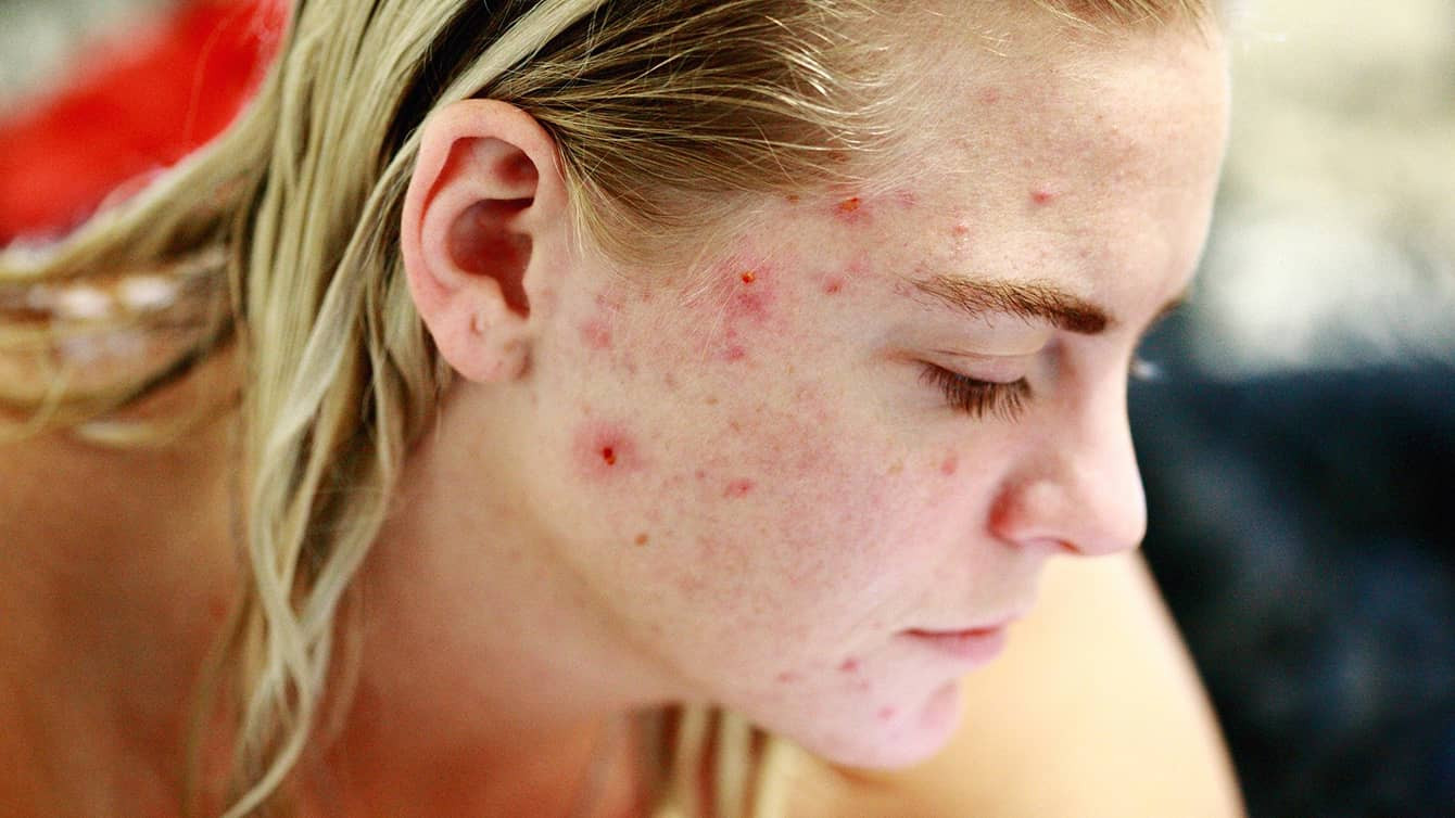 Huiles essentielles pour lutter contre l’acne et les boutons